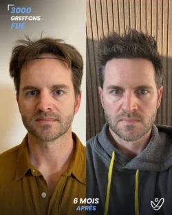 Greffe de Cheveux FUE 3000 greffons 6 mois apres