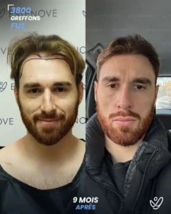 Greffe de Cheveux FUE 3800 greffons 9 mois apres