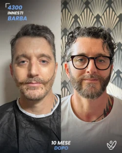 maschile barba 4300 innesti 10 mesi prima e dopo maschile barba 4300 innesti 10 mesi prima e dopo