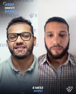 maschile barba 4500 innesti 6 mesi prima e dopo maschile barba 4500 innesti 6 mesi prima e dopo