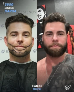 maschile barba 3600 innesti 6 mesi prima e dopo maschile barba 3600 innesti 6 mesi prima e dopo