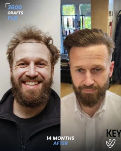 FUE Hair Transplant 3600 Grafts 14 Months Before&After FUE Hair Transplant 3600 Grafts 14 Months Before&After